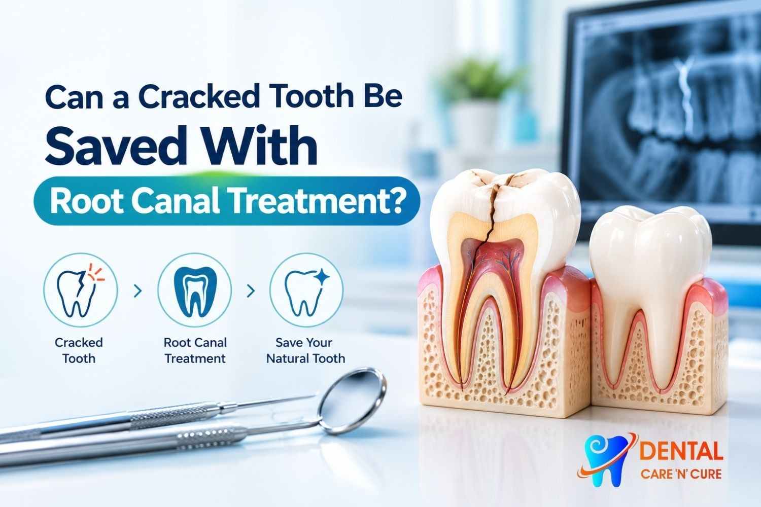 Root canal treatment for a cracked tooth with dental crown restoration